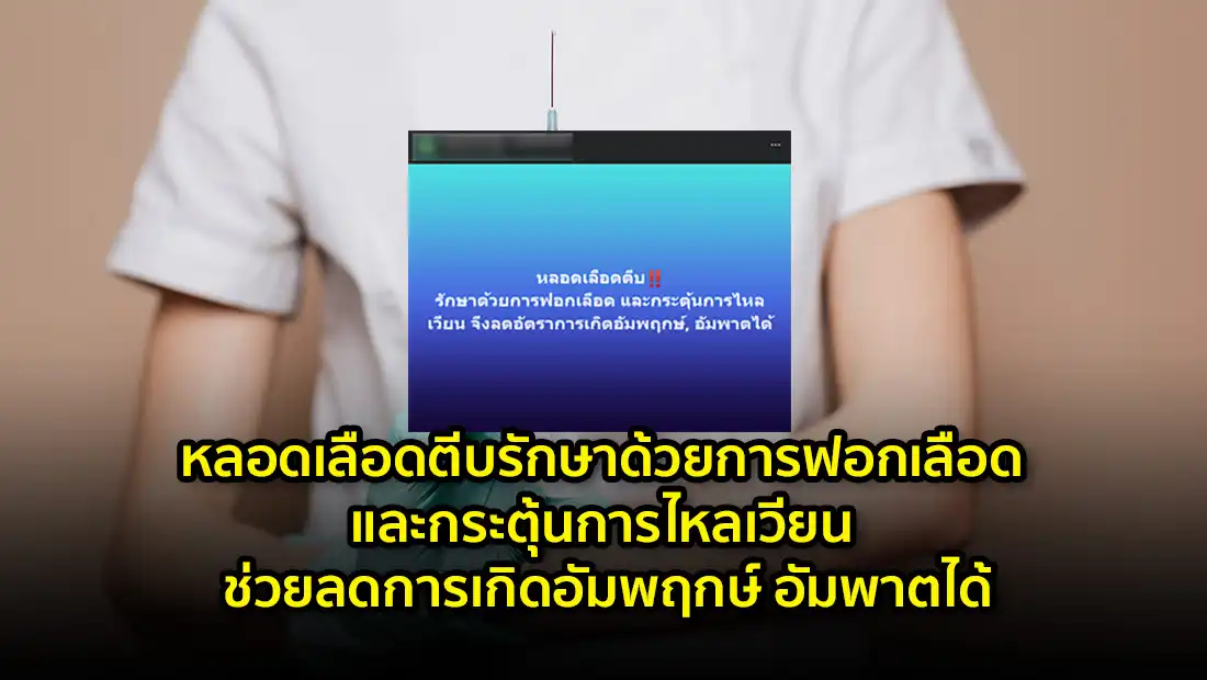 หลอดเลือดตีบรักษาด้วยการฟอกเลือด และกระตุ้นการไหลเวียน
