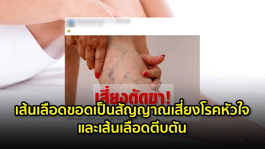 เส้นเลือดขอดเป็นสัญญาณเสี่ยงโรคหัวใจ