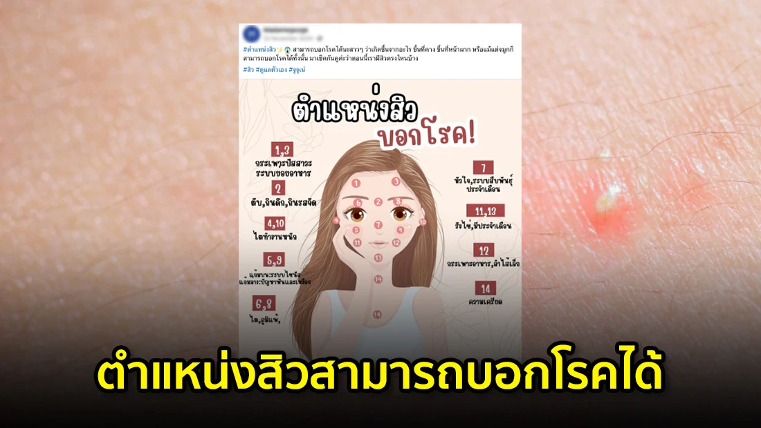 ตำแหน่งสิวสามารถบอกโรคได้