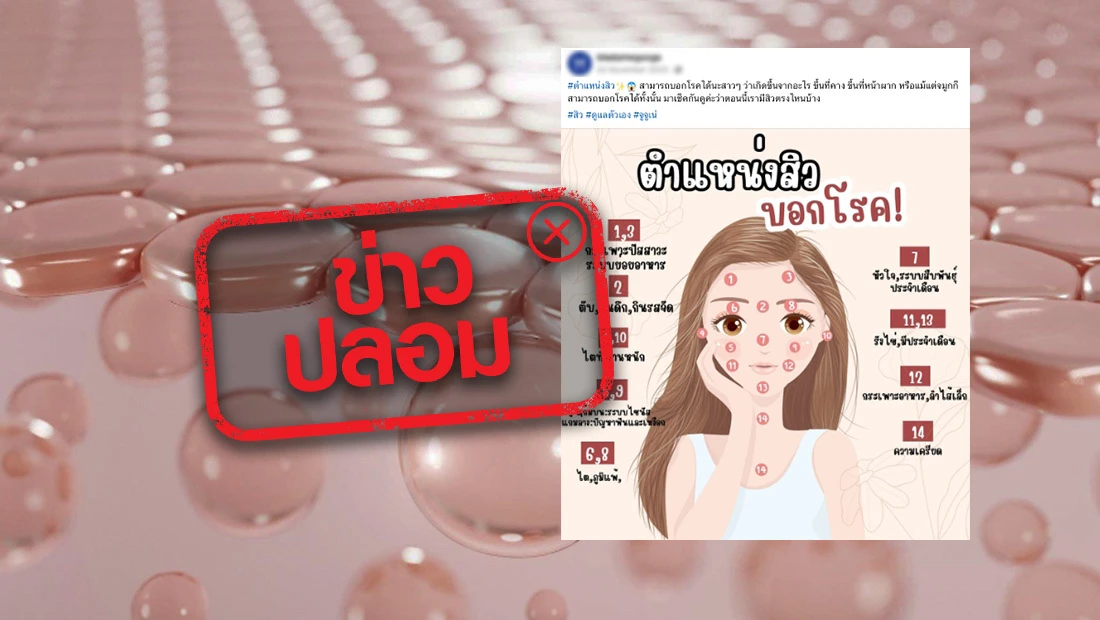 ตำแหน่งสิวสามารถบอกโรคได้