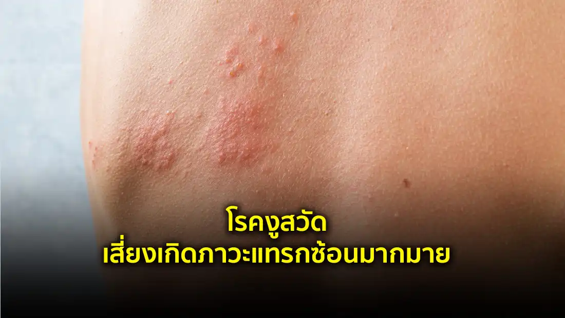 โรคงูสวัด