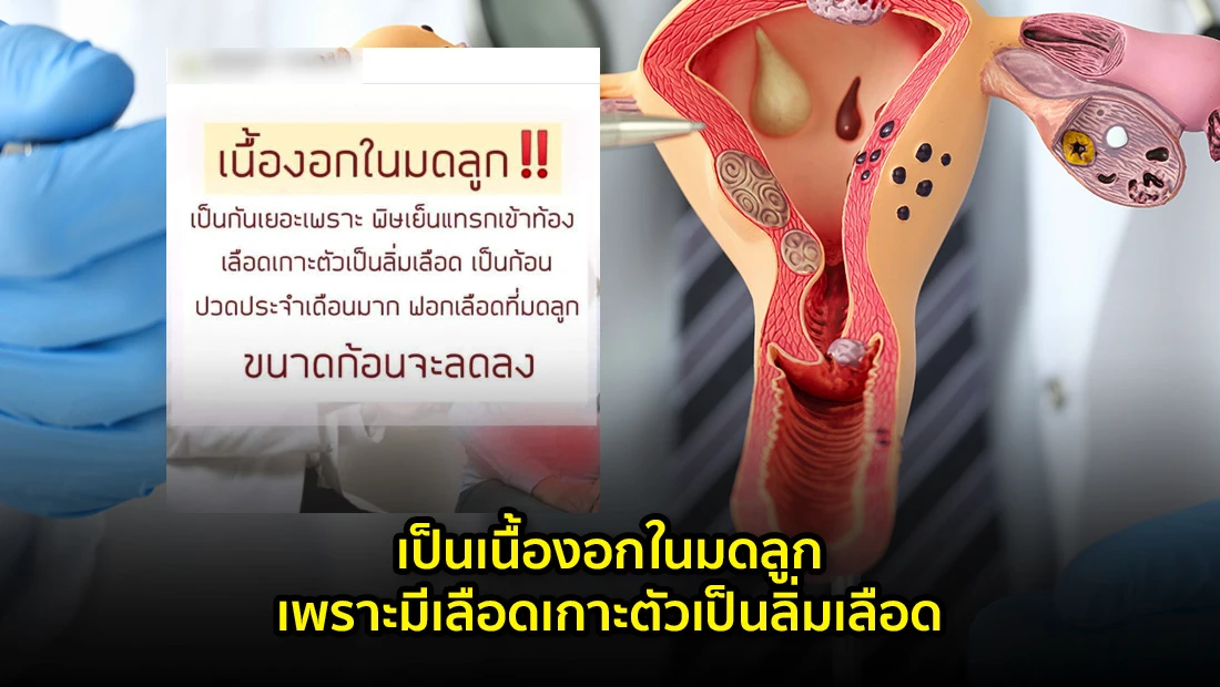 เป็นเนื้องอกในมดลูกเพราะมีเลือดเกาะตัวเป็นลิ่มเลือด