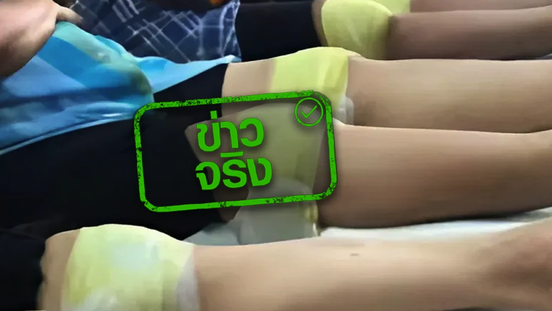 สปสช. เพิ่มบริการพอกเข่า สำหรับผู้ป่วยบัตรทอง