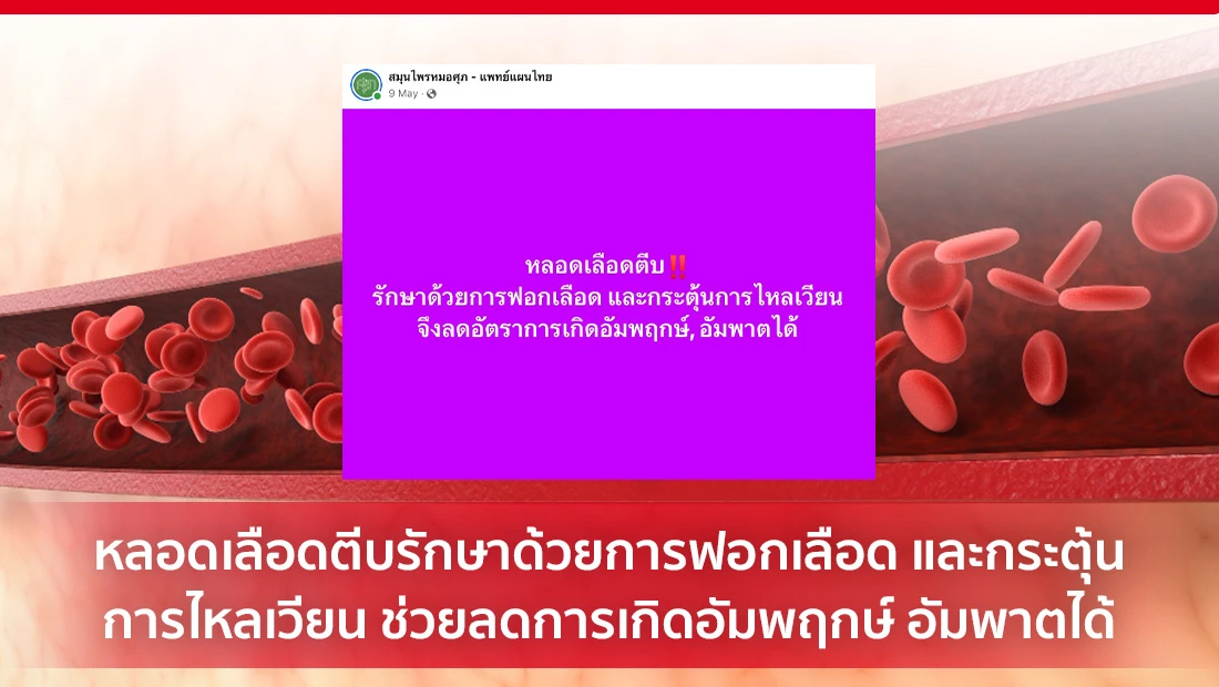 หลอดเลือดตีบ