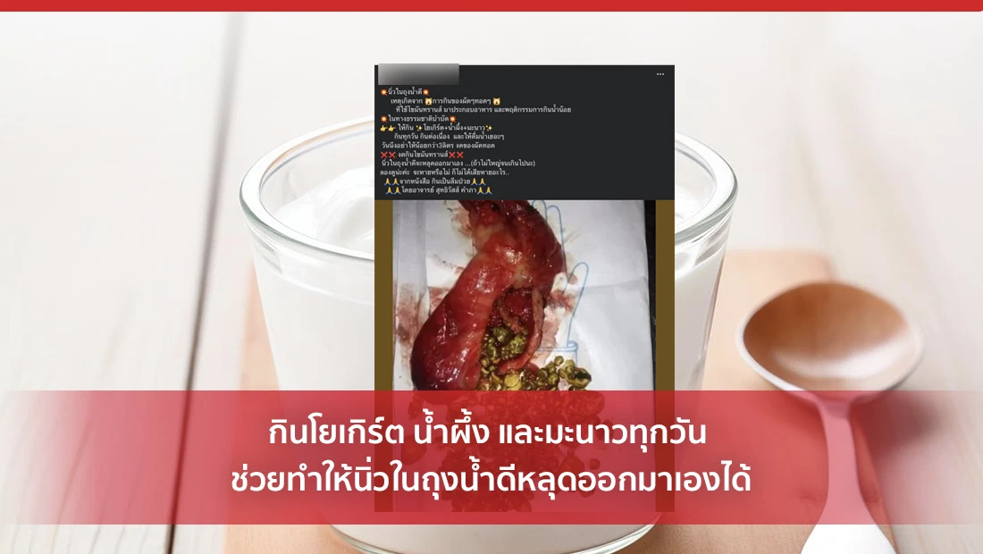 กินโยเกิร์ต น้ำผึ้ง และมะนาวทุกวัน ช่วยทำให้นิ่วในถุงน้ำดีหลุด