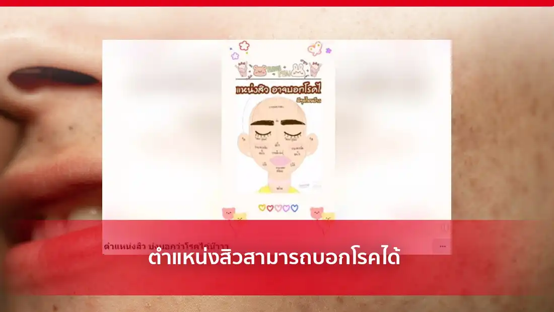 สิวสามารถบอกโรค
