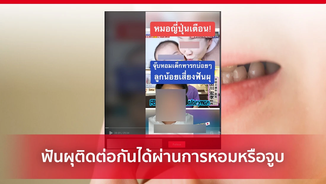 ฟันผุติดต่อกันได้ผ่านการหอมหรือจูบ