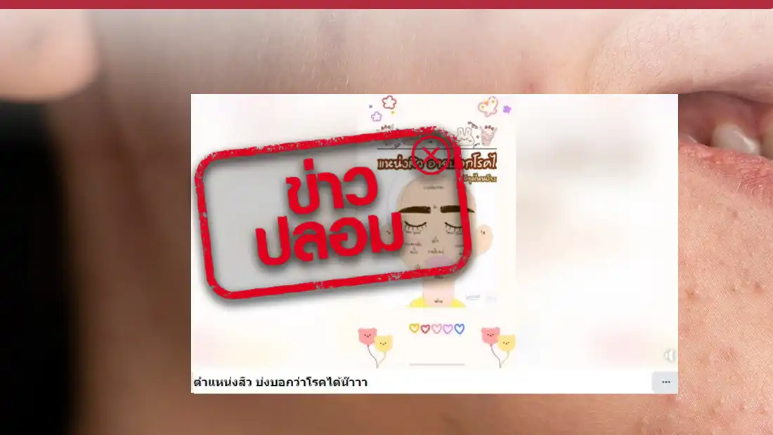 สิวสามารถบอกโรค