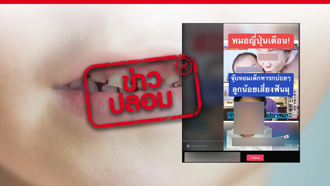 ฟันผุติดต่อกันได้ผ่านการหอมหรือจูบ