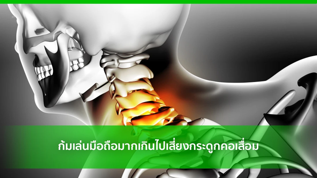 กระดูกคอเสื่อม