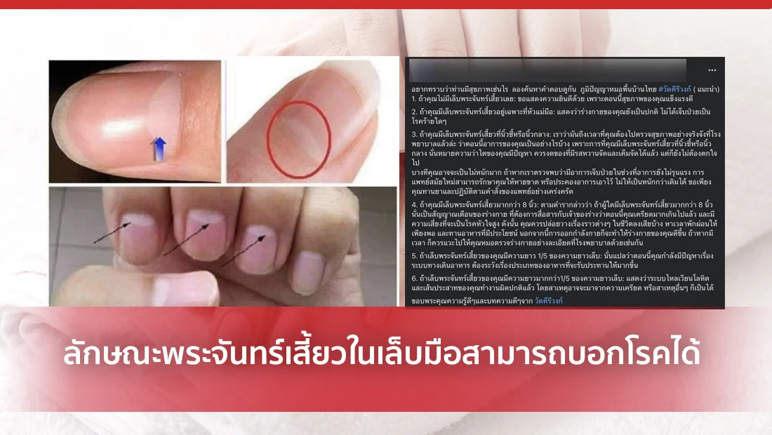 พระจันทร์เสี้ยวในเล็บมือ