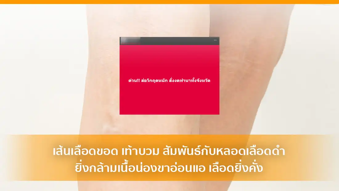 เส้นเลือดขอด เท้าบวม