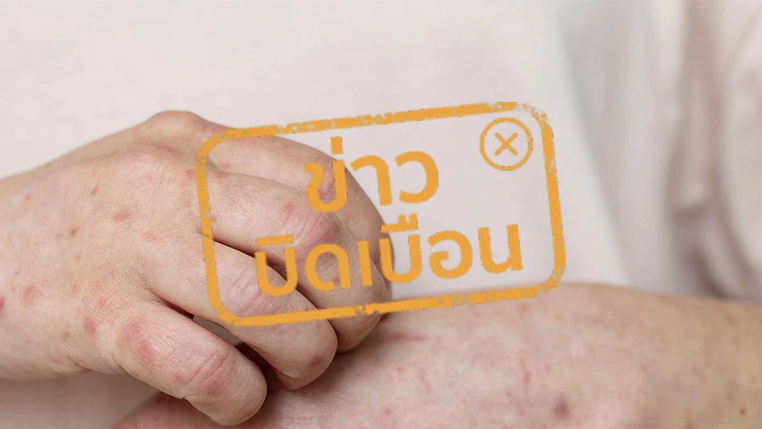 การติดเชื้อ HIV HPV และฝีดาษลิง มีสาเหตุจากการมีเพศสัมพันธ์ทางทวาร