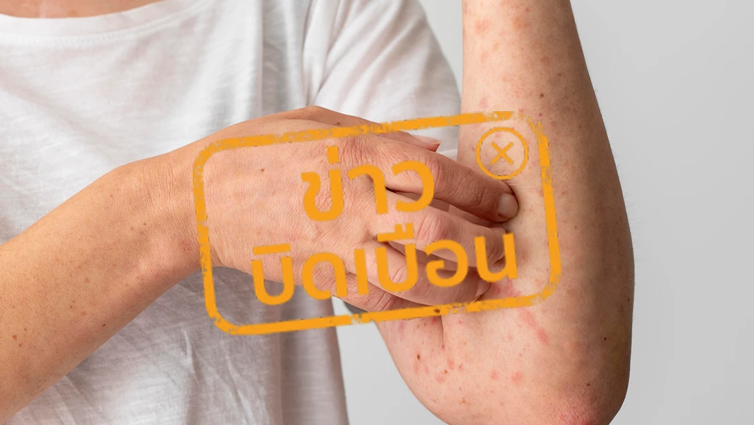 ภาพแสดงลักษณะเฉพาะของการเกิดผื่น 