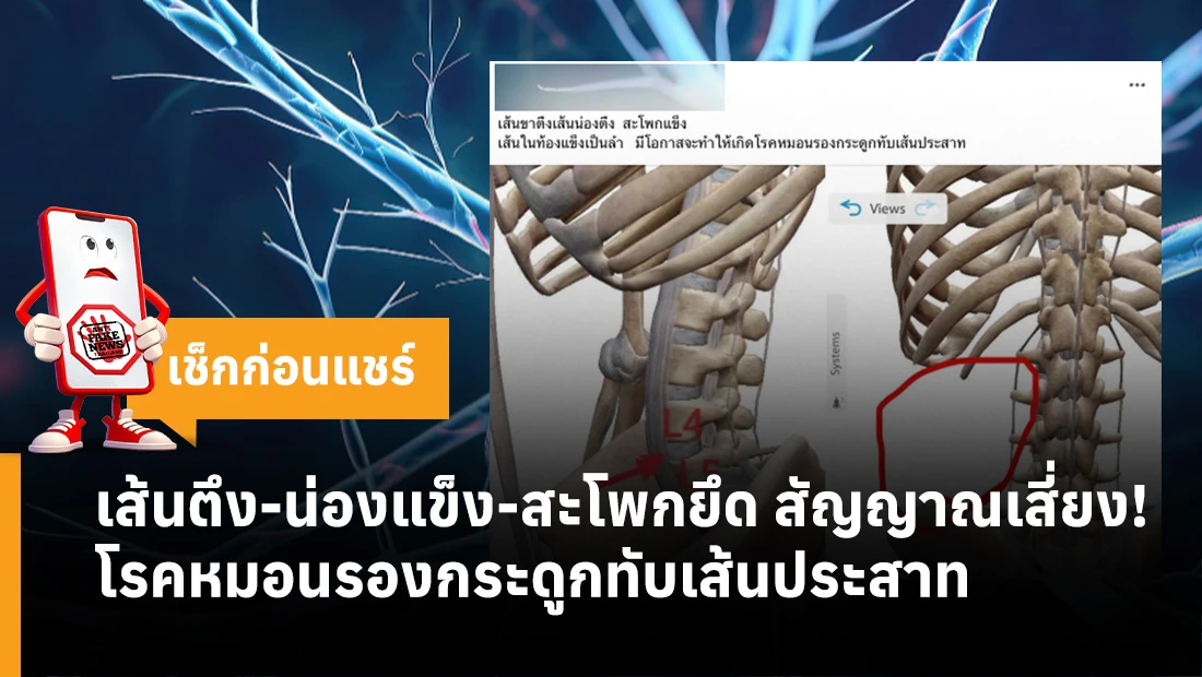 โรคหมอนรองกระดูกทับเส้นประสาท