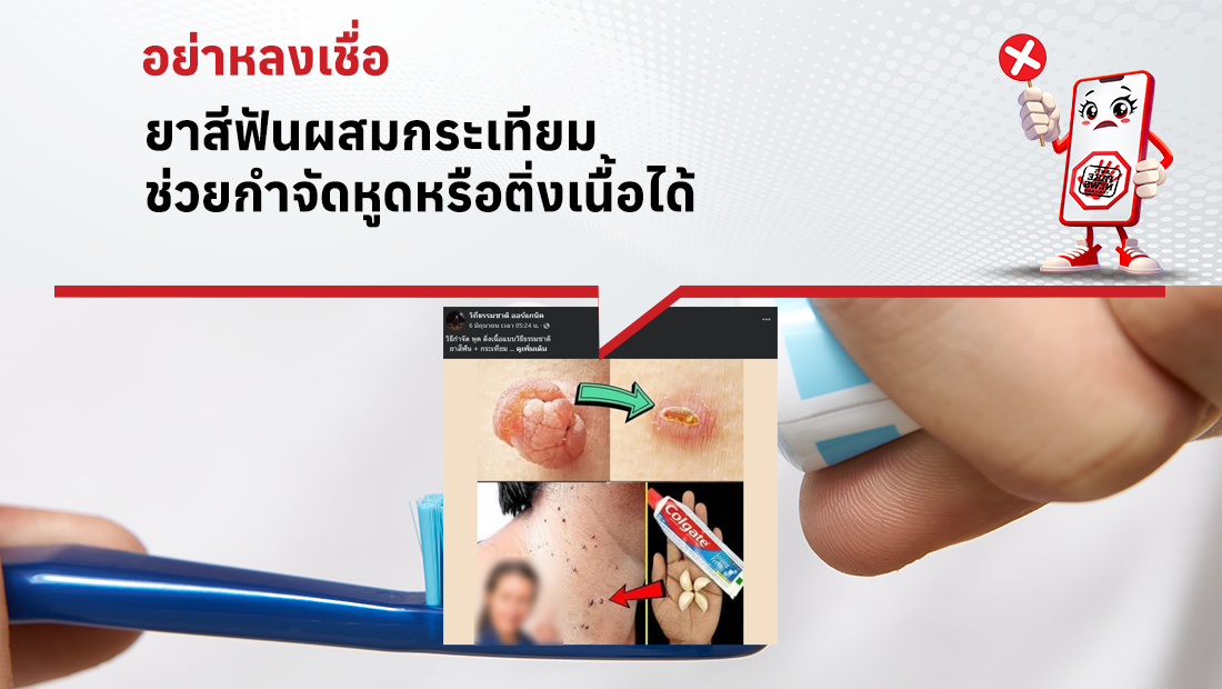ยาสีฟันผสมกระเทียม ช่วยกำจัดหูดหรือติ่งเนื้อได้