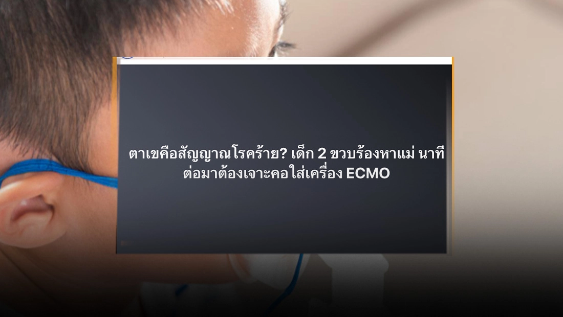ตาเขในเด็กเล็ก เป็นสัญญาณเตือนโรคร้าย อาจต้องใช้ ECMO เครื่องช่วยพยุงหัวใจและปอด