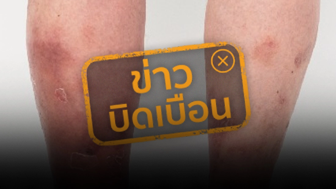 7 สัญญาณ น้ำเหลืองไหลเวียนไม่ดี
